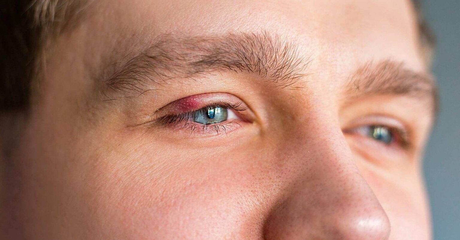 Warum Ist Ein Auge Größer Als Das Andere? Was Verursacht Unterschiedlich Große Augen?